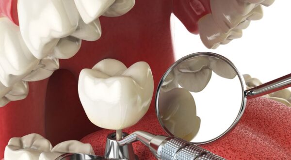 Precise and safe dental implant placement using advanced technology at Friedman Dental Group.