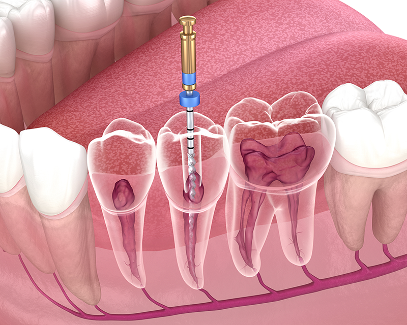 Root Canals