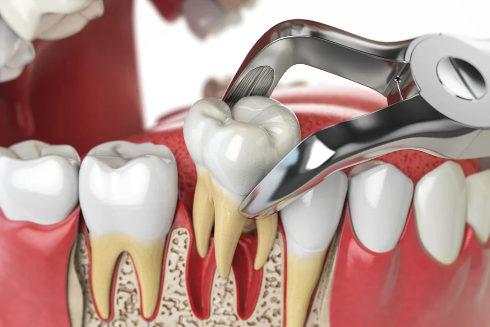 Benefits of Tooth Extractions 