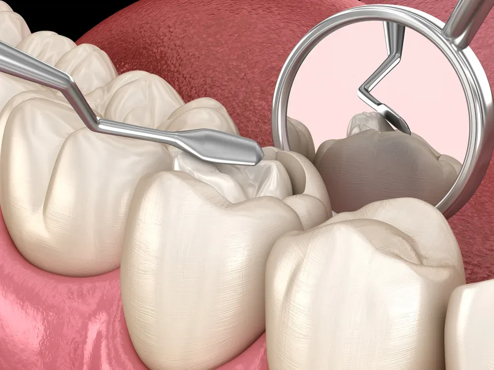 Fillings