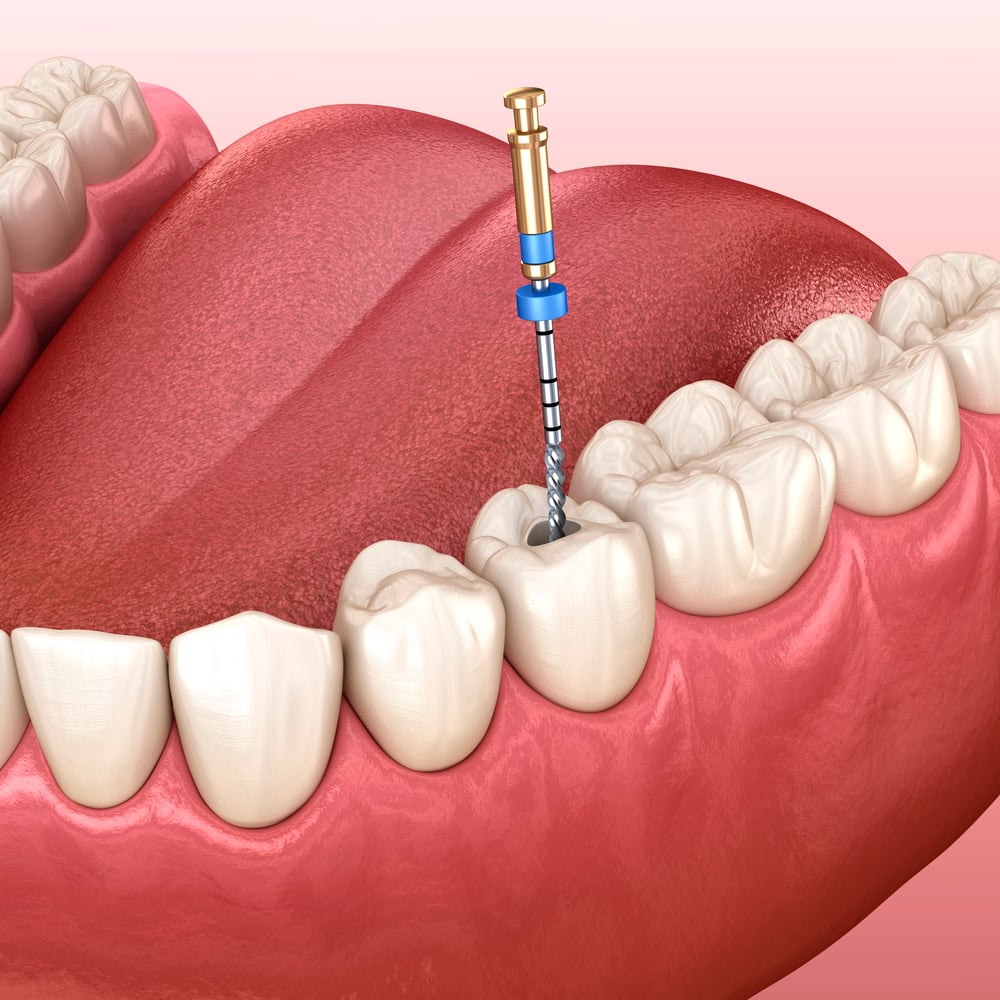 Benefits of Root Canals