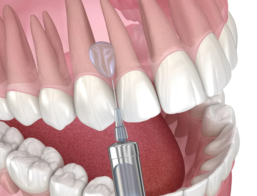 Sedation Dentistry