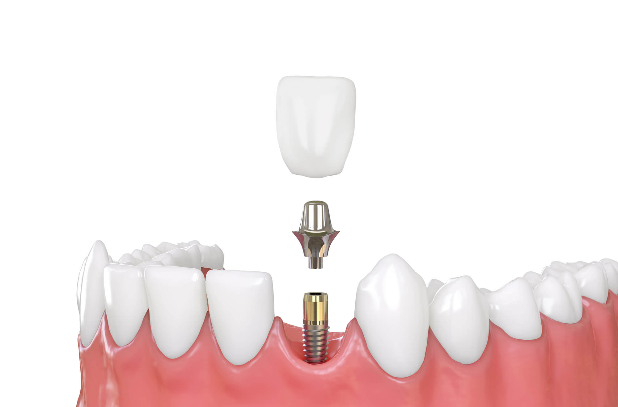 3D image of Tamarac Dental Implants