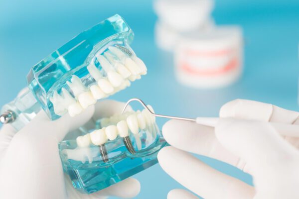 Tamarac Dental Implants model