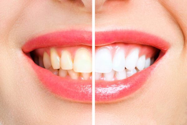before and after Teeth whitening Coral Springs