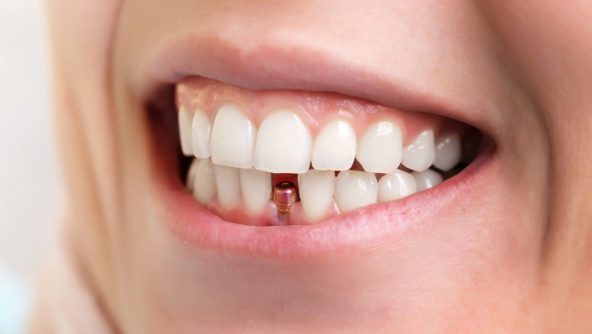 dentist checking patient's Tamarac Dental Implants