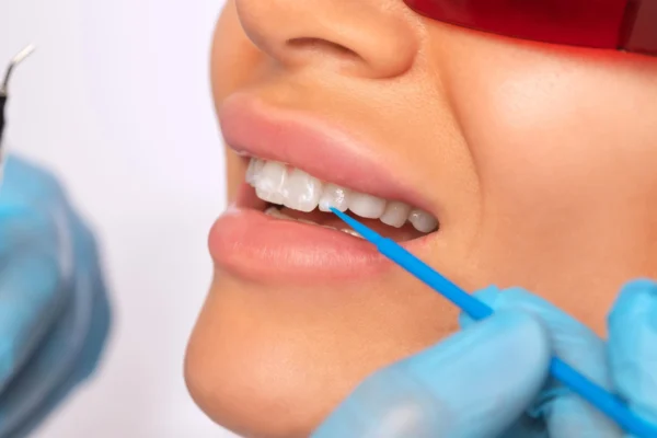 Coral Springs cosmetic dentist performs dental bonding