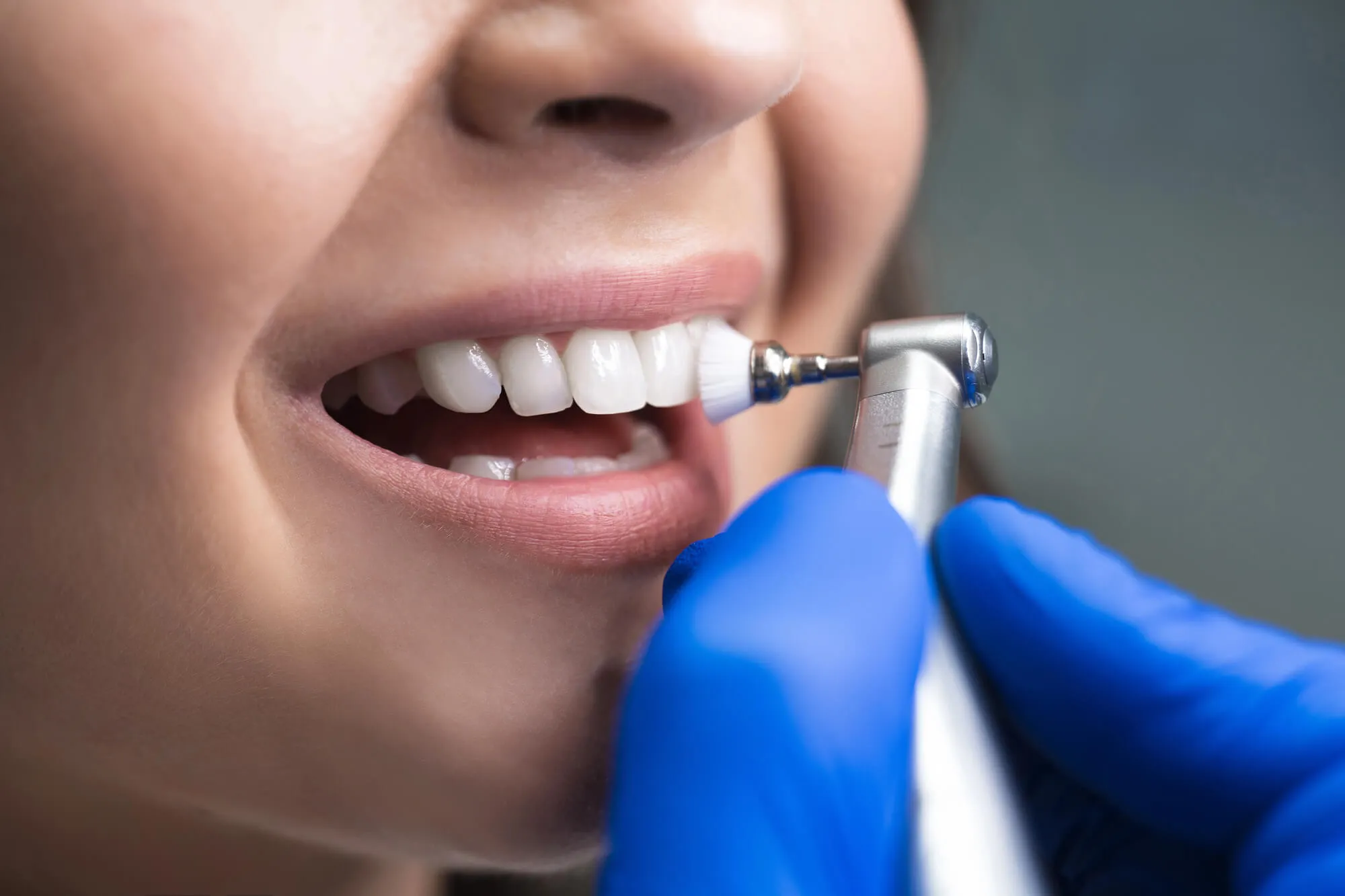 miami dental cleaning