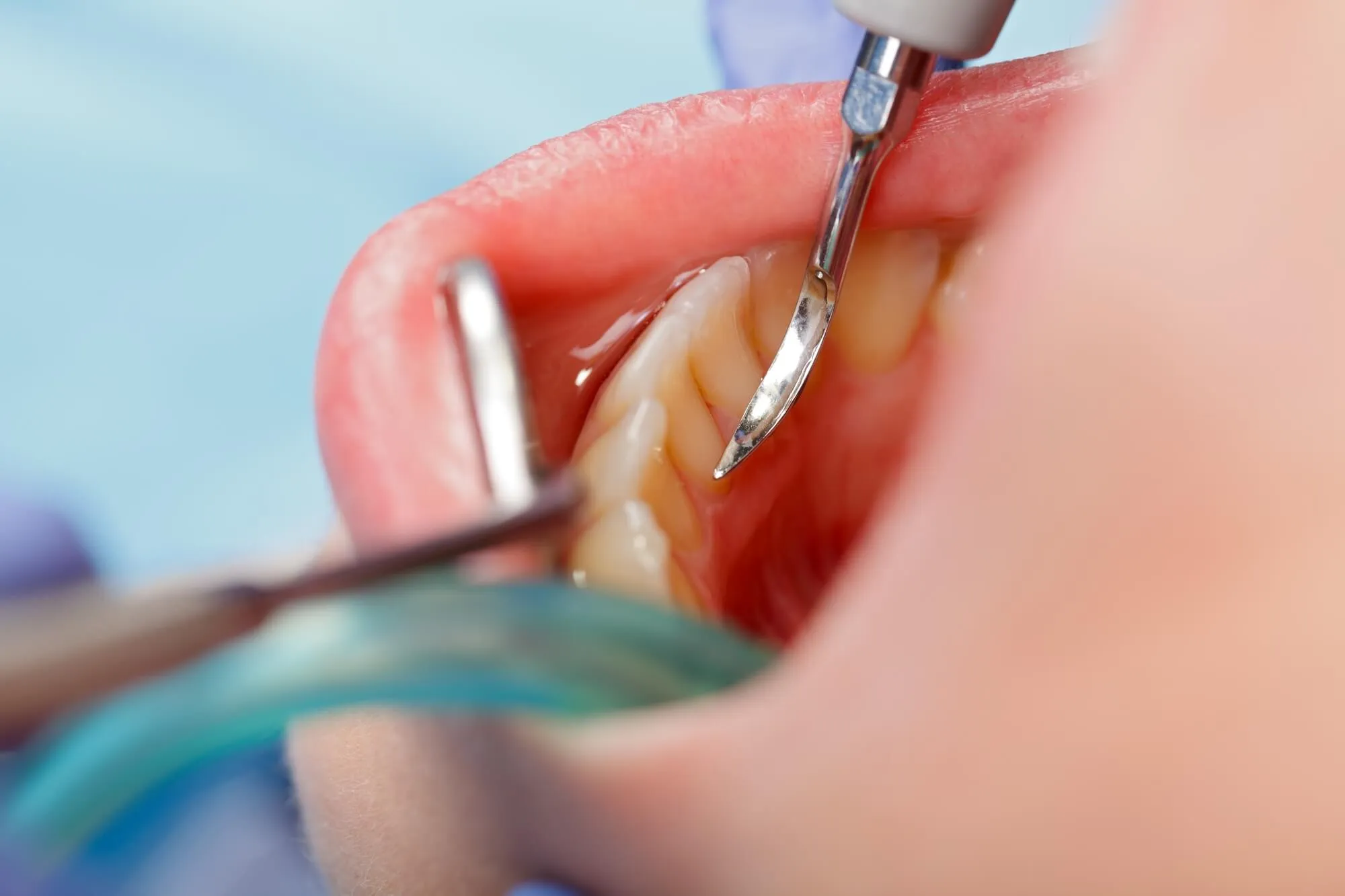 professional miami dental cleaning