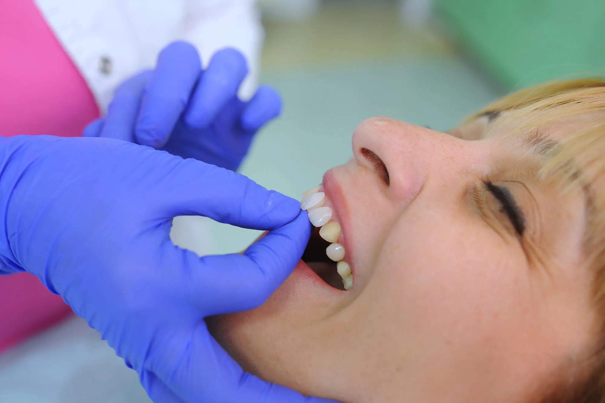 putting on same day veneers miami