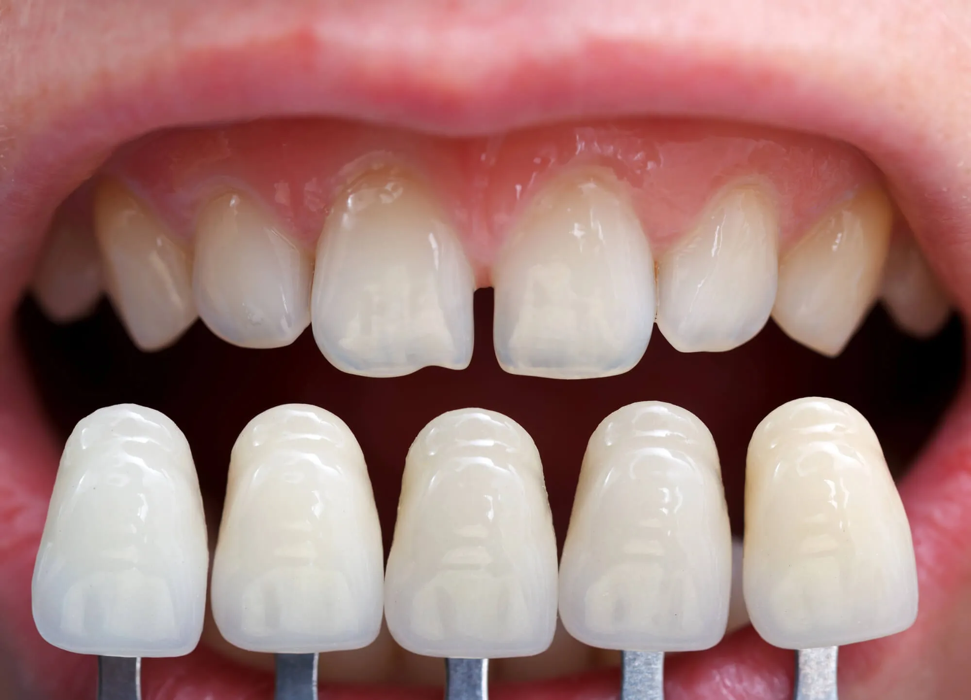 veneers miami shade guide
