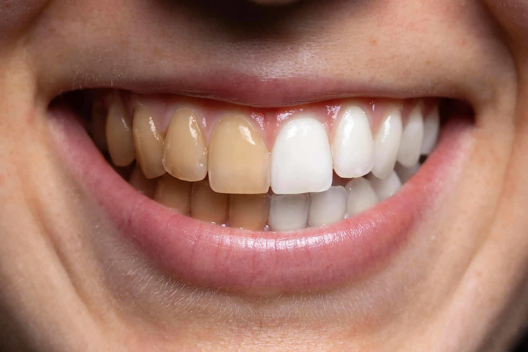 before and after Cosmetic Dentistry Miami