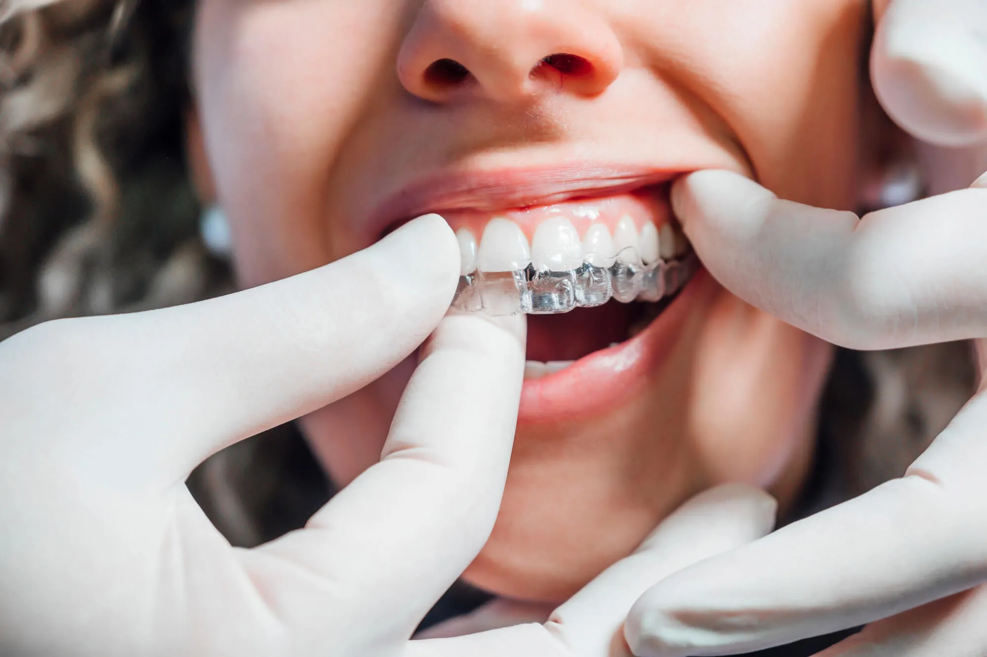 patient trying on Invisalign Miami