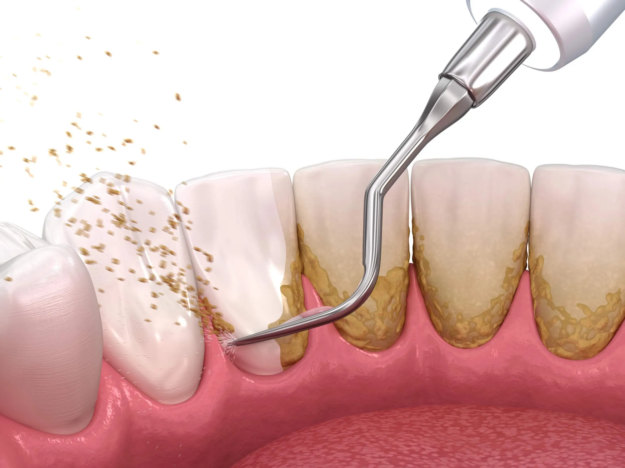 dentist coral springs removes tartar