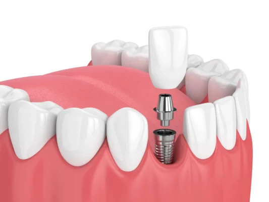 illustration of Best Dental Implants in Miami