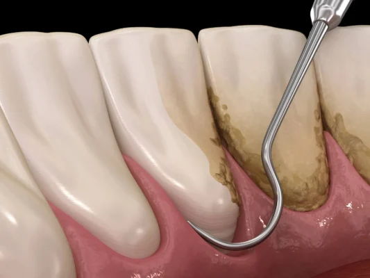 illustration of dentist coral springs removing plaque
