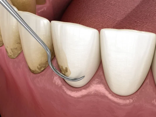 close-up-of-teeth-cleaning-miami