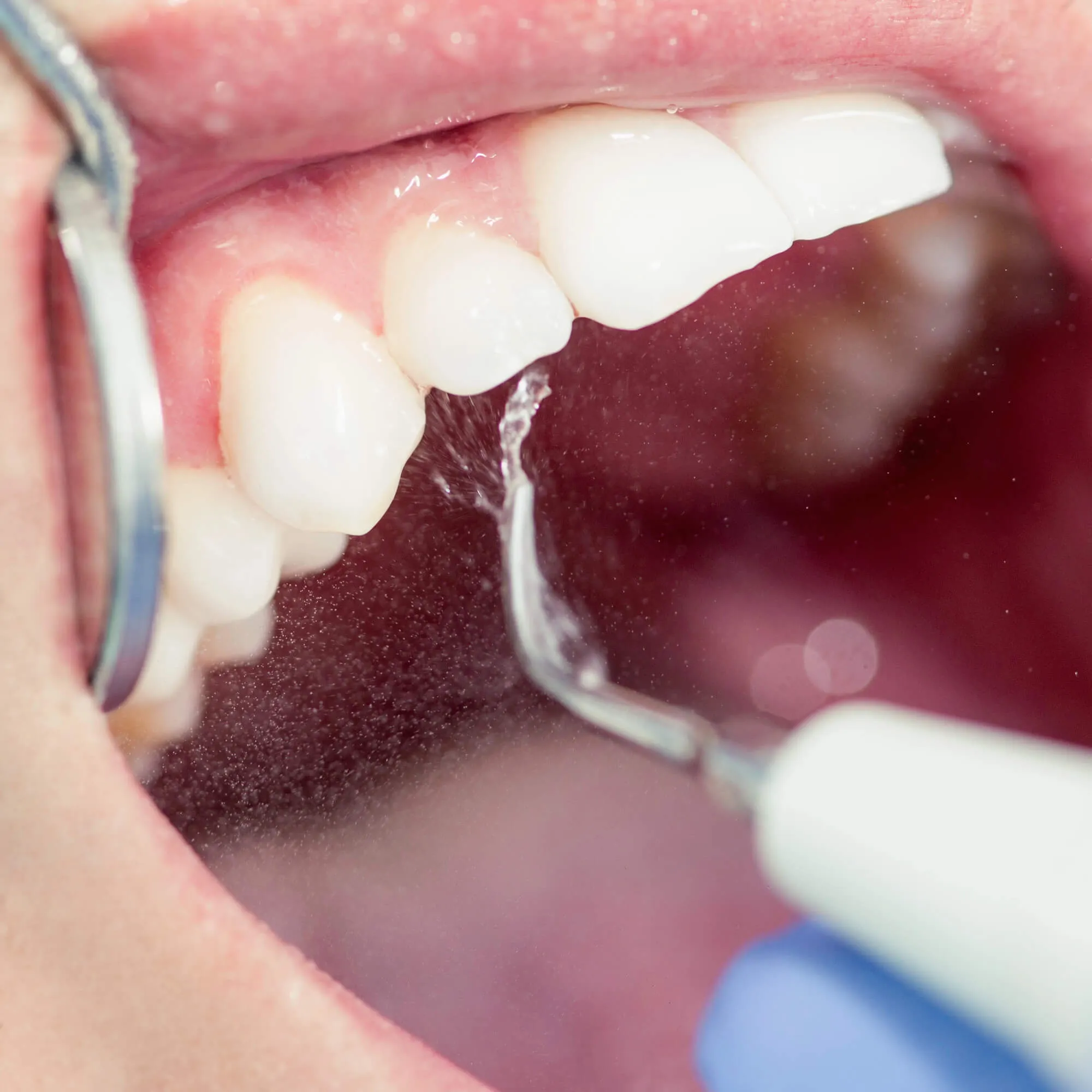 routine-teeth-cleaning-miami