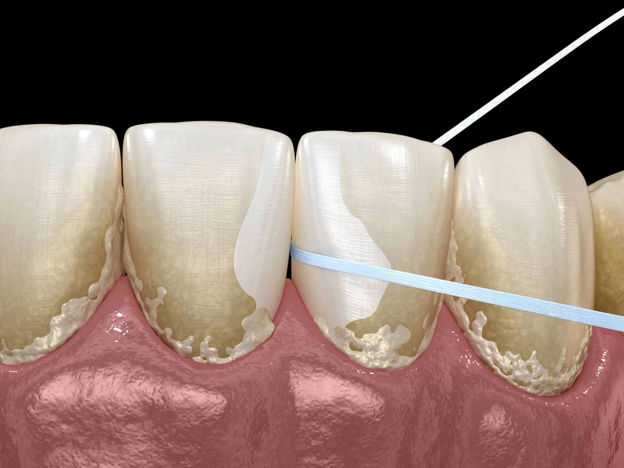 teeth-cleaning-miami-illustration