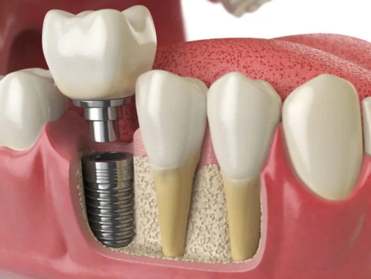 Dental Implants Miami