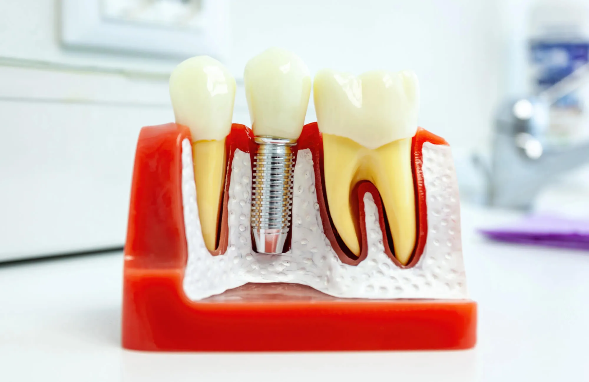 a closer look at dental implants tamarac humana