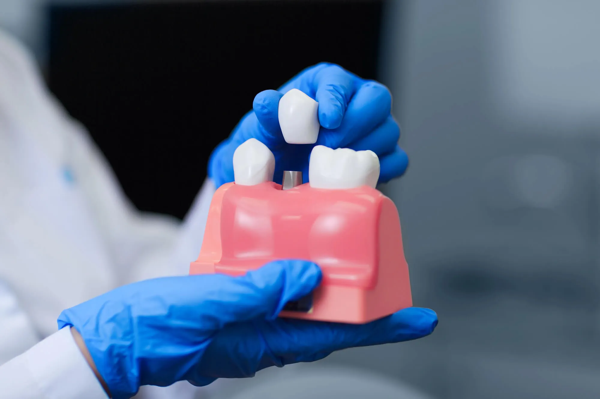 dental implants coral springs fl model