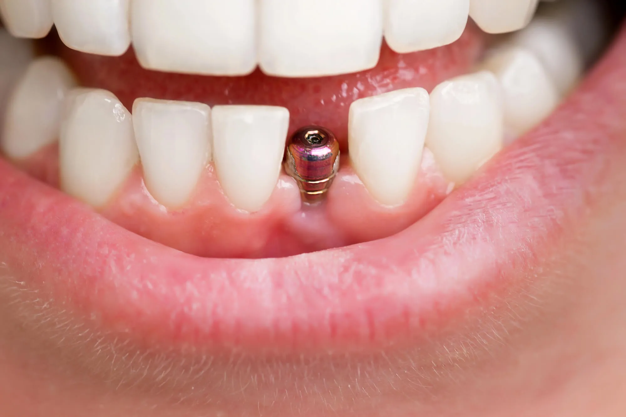 dental implants tamarac