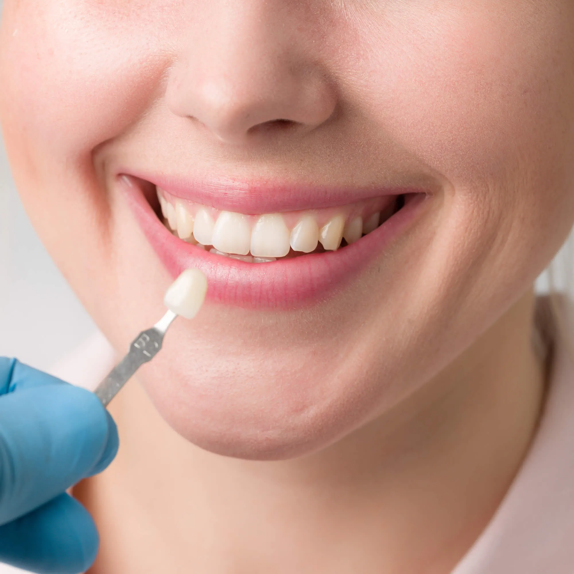 veneers Cosmetic Dentistry Miami